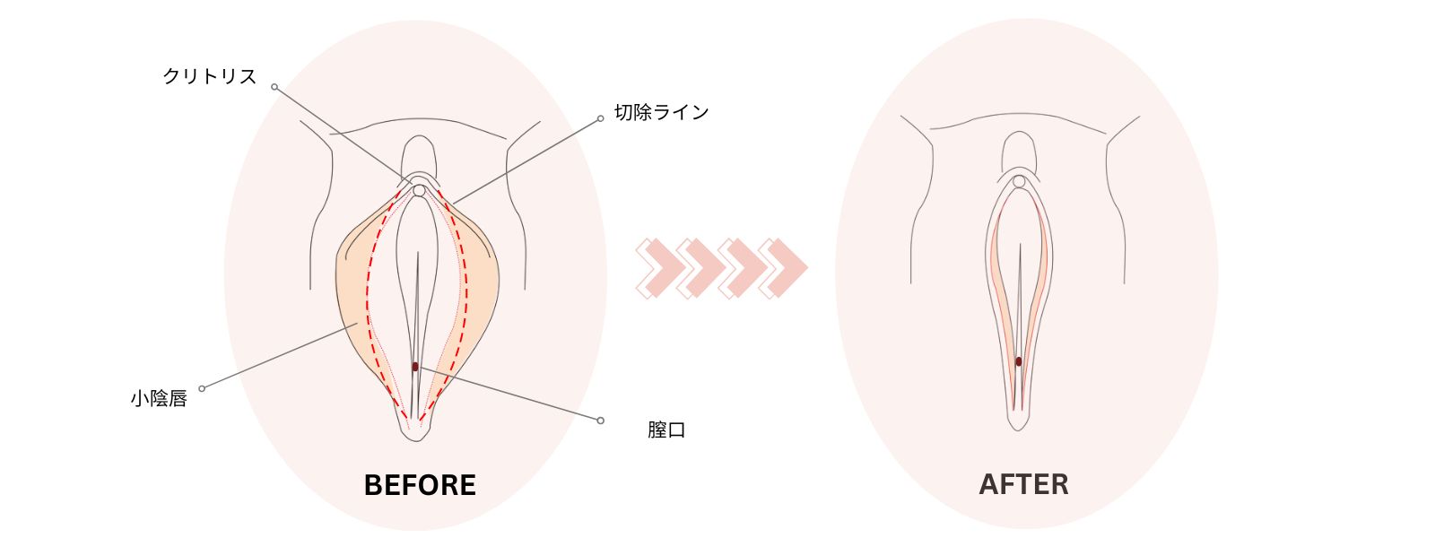 医学 陰唇 写真 膣 